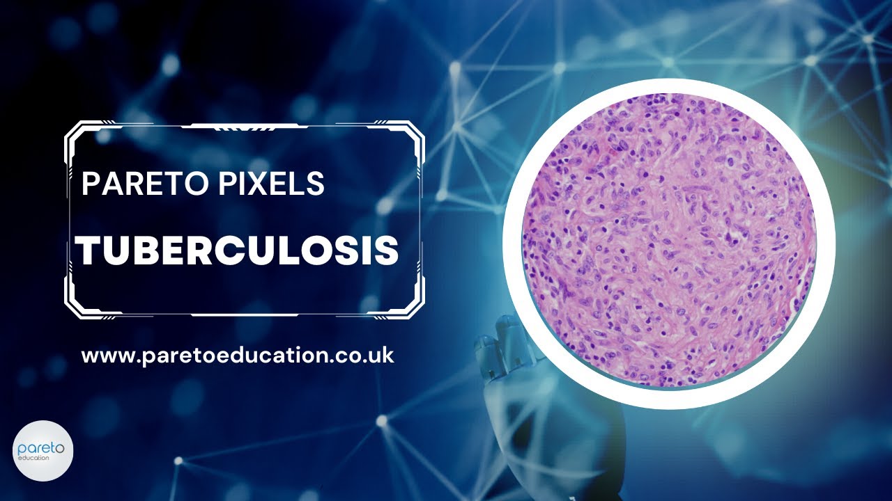 Tuberculosis (TB): Pathophysiology and Diagnosis