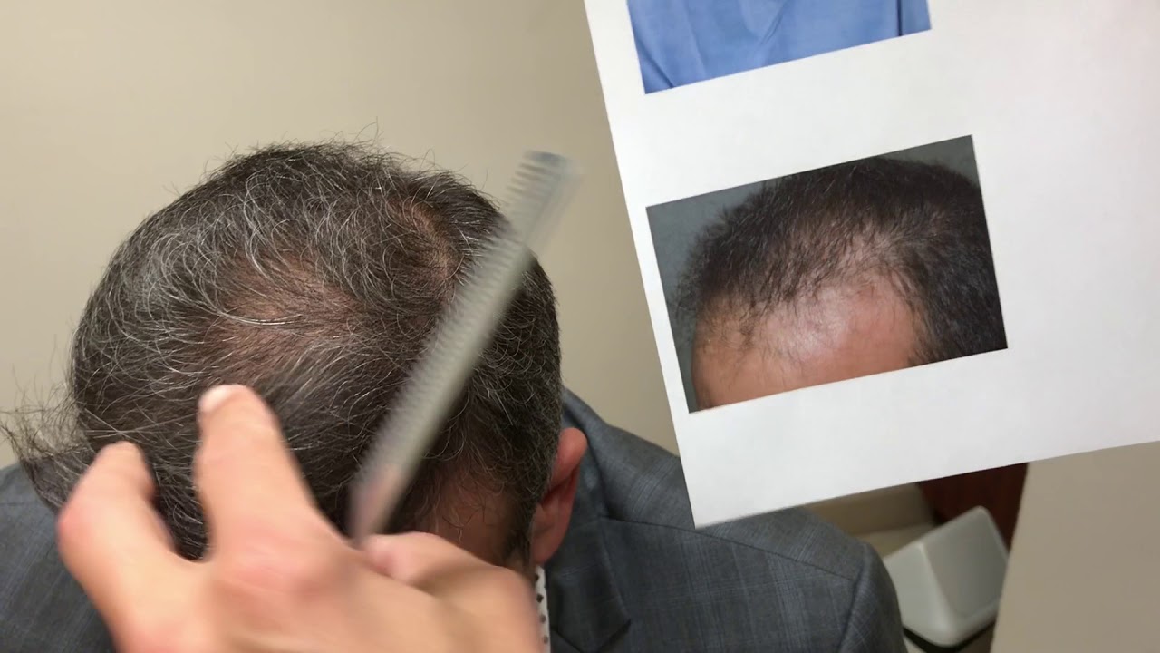 FUE hair transplant result - 2600 grafts