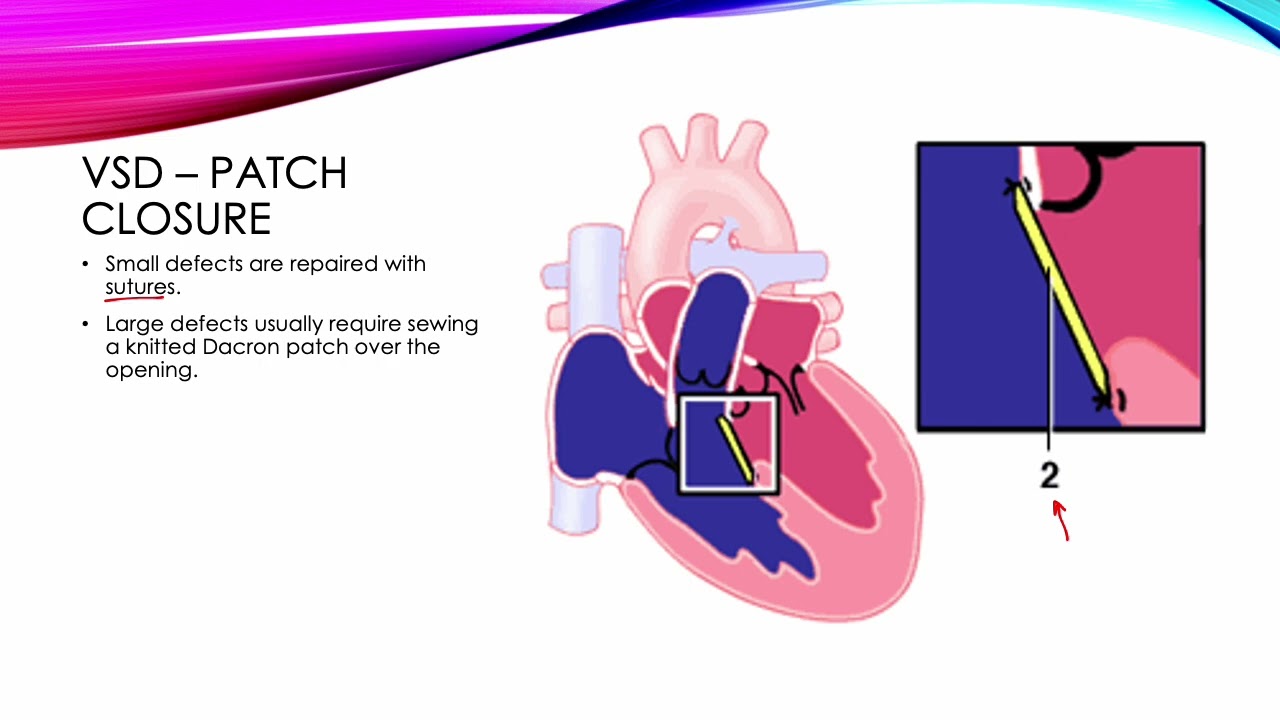 Pediatric Cardiac - Congenital Heart Defects (3/3)