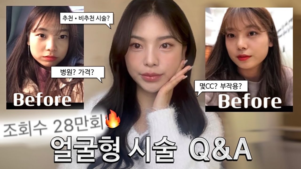 조회수 28만회🔥사각턱 얼굴형 시술 Q&A + 입술필러 (추천&비추천 시술&bull;부작용&bull;병원&bull;가격 ?) 문의 폭주..궁금증 해결해드립니다‼️(인모드/보톡스/필러/윤곽)