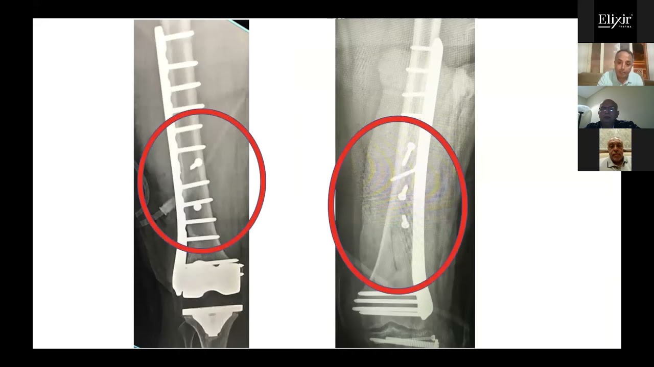 Violation of Principles in Distal Femoral Fracture Fixation  |  Prof. Wael Samir