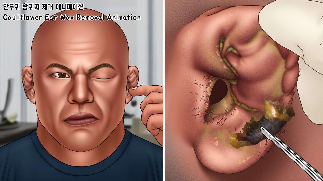 ASMR 아~주 오래된 만두귀 왕귀지 제거 애니메이션 | 귀청소 | Very Old Cauliflower Ear Wax Removal Animation | Ear Cleaning