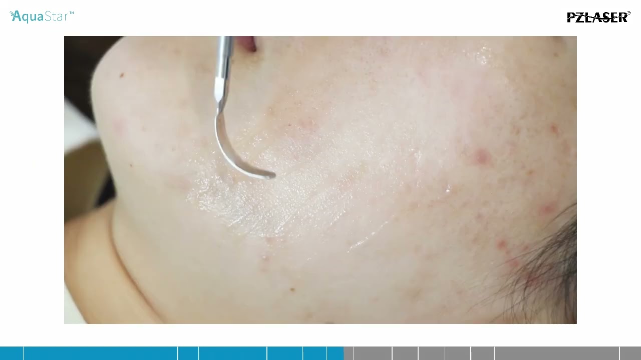 78#AquaStar  Hydrafacial Device- Operation Guidance