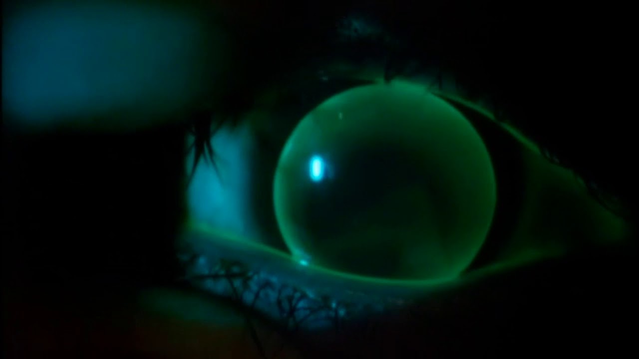 Instructional Video: Assessment of a Gas Permeable Contact Lens