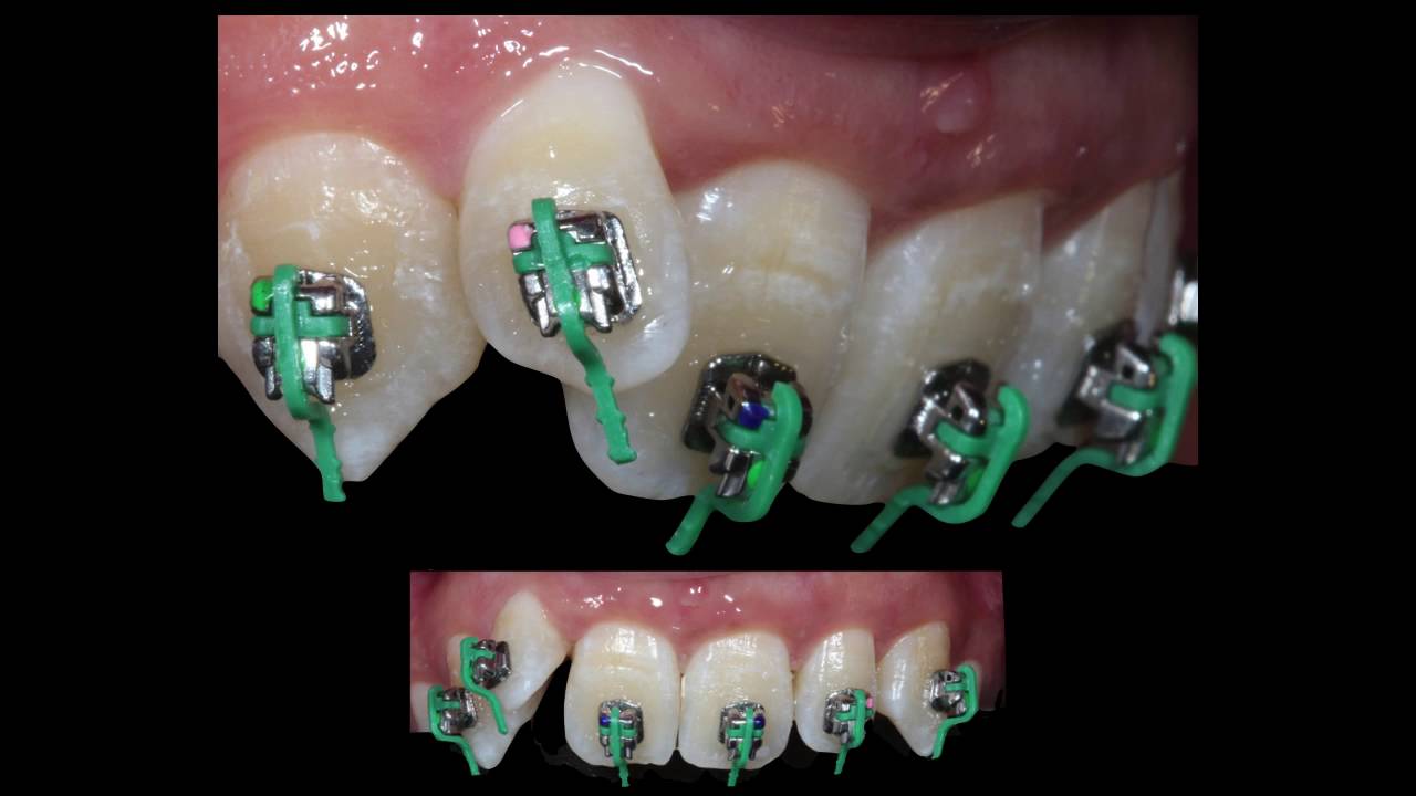 Orthodontic treatment of Class II division 2, Damon ,deep bite -anterior bite turbo by Dr. Amr Asker