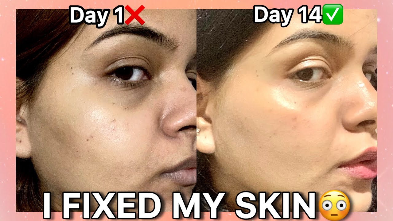 How I Got Rid of Hyperpigmentation & Dark Spots | Skincare Mistakes + What Actually Works
