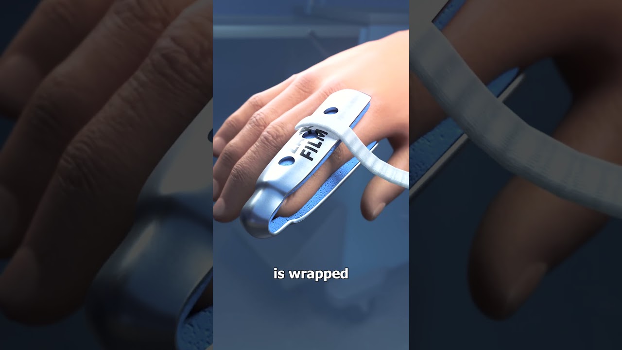How Finger Splints Work 🤨