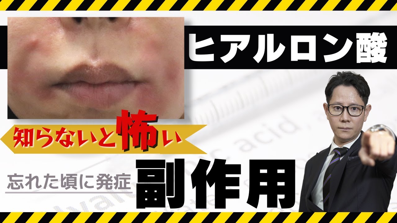 【遅発結節×コロナワクチン】知っておきたいヒアルロン酸の副作用を皮膚科医が解説【リスク】