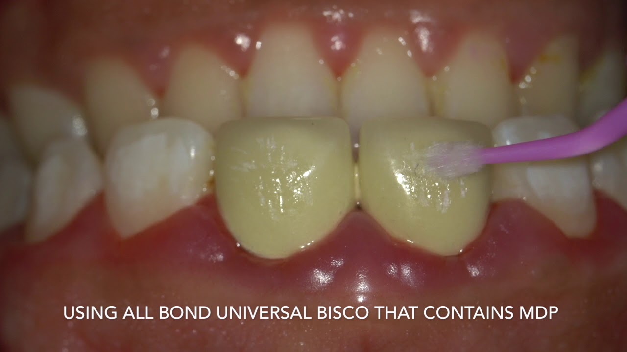 orthodontic brackets bonding to porcelain crowns by dr Amr Asker