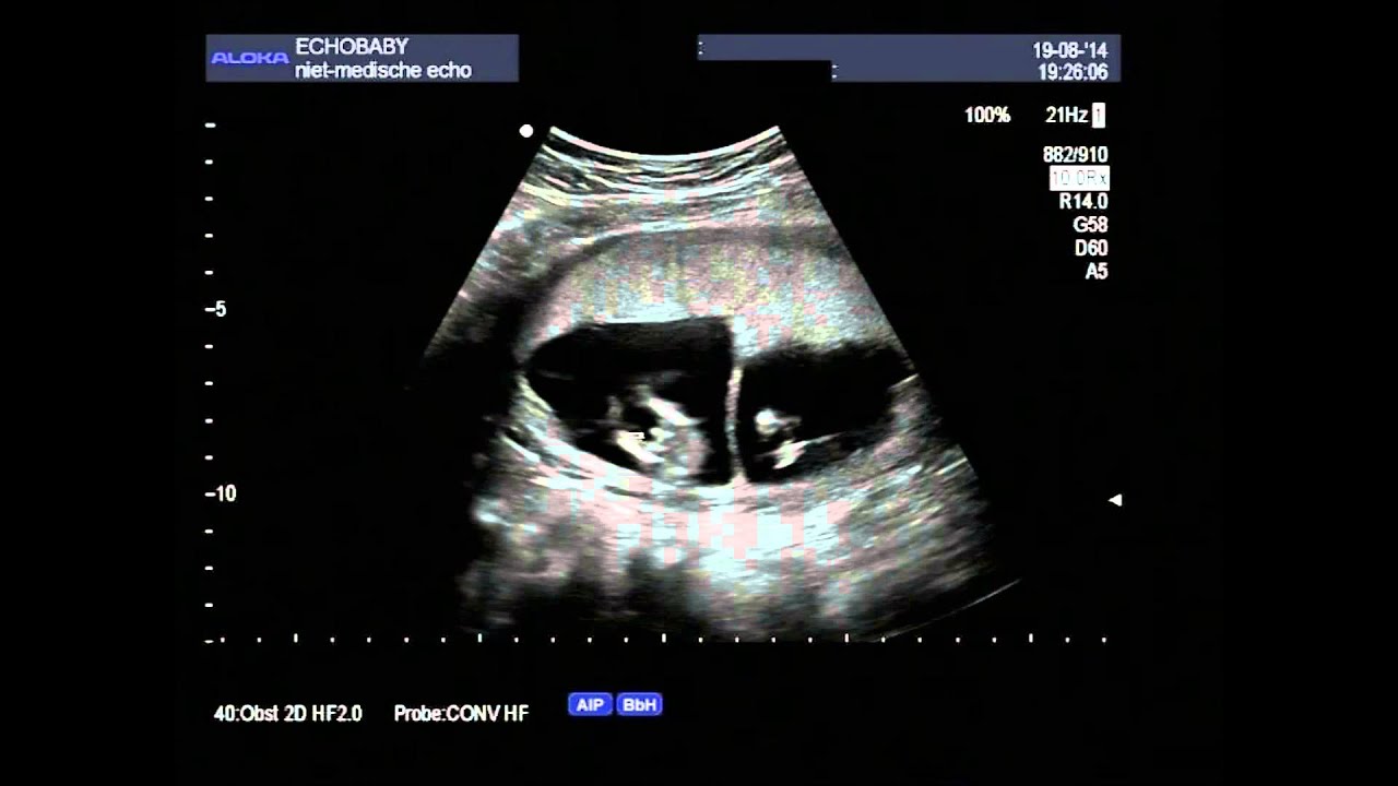 2 en 3D-echo Drieling 13 Weken Zwanger Geslachtsbepaling, met ingesproken uitleg