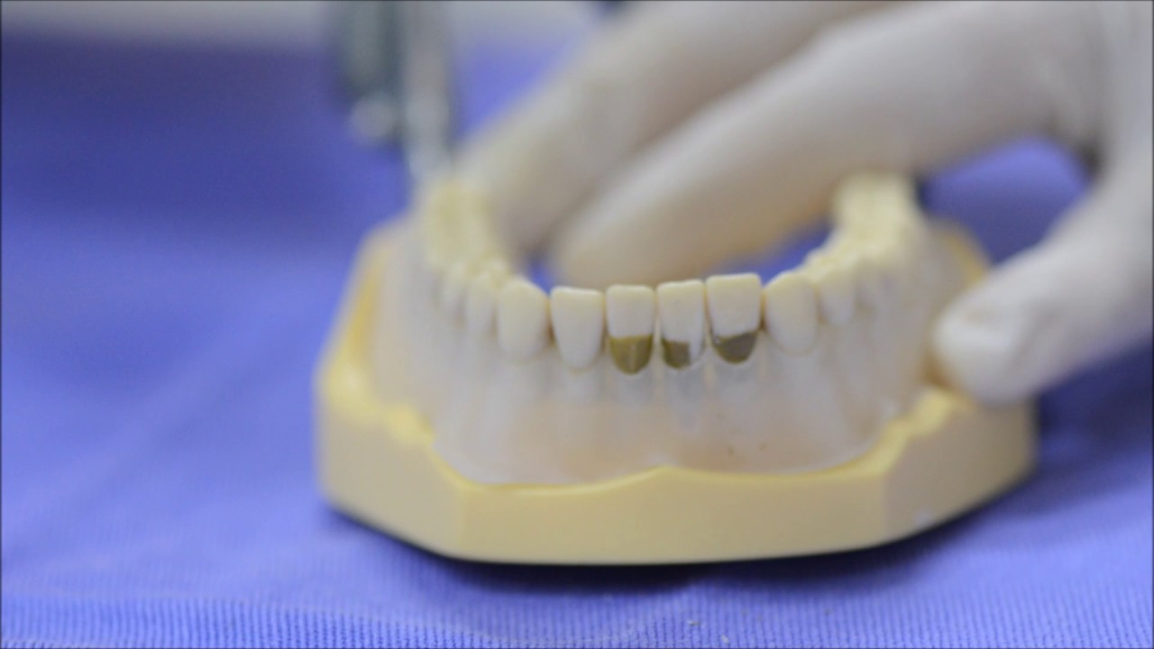 Vídeo de raspagem periodontal