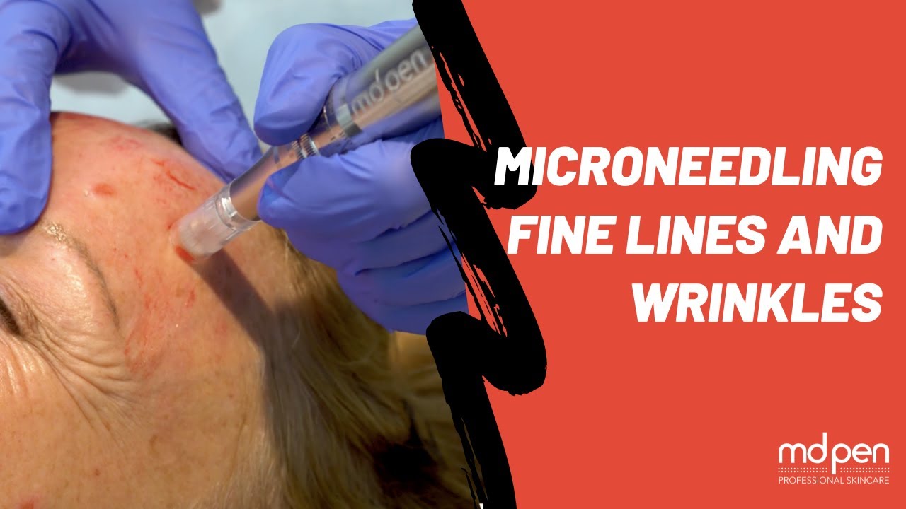 Microneedling Fine Lines and Wrinkles