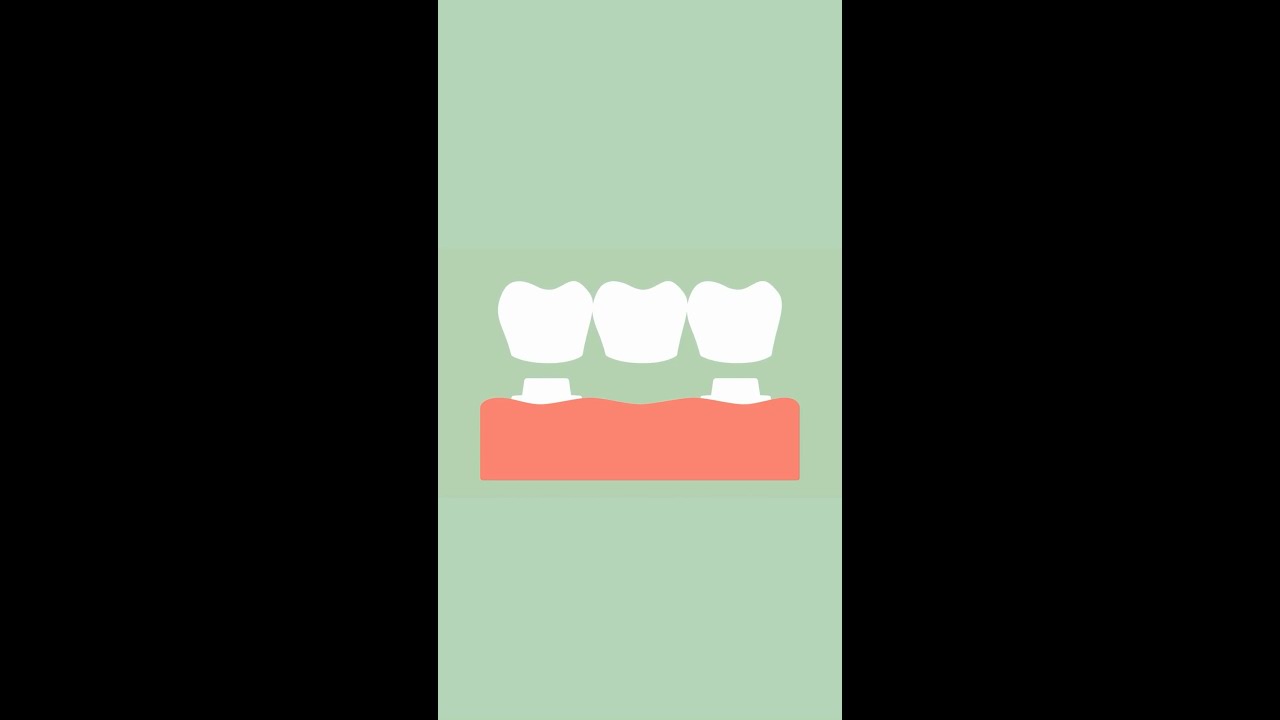 Dental Implant vs Bridge