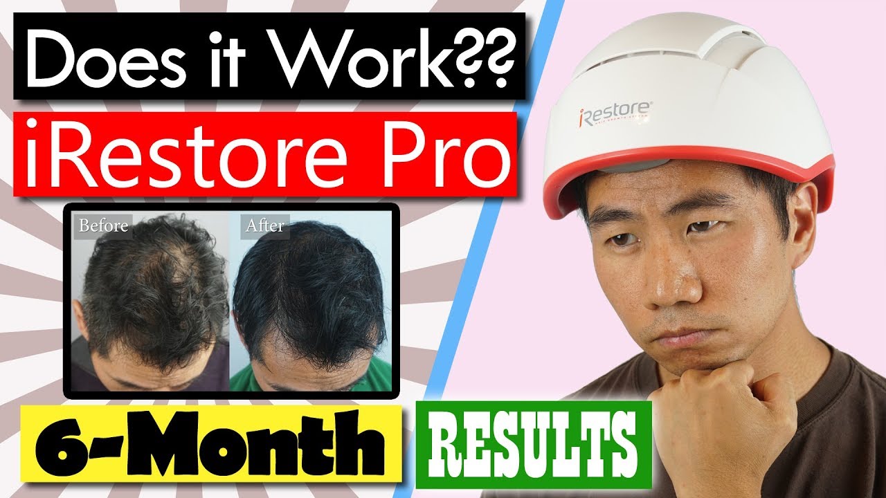 Do LLLT Laser Hair Restoration Helmets Work? iRestore Pro Review Ep. 4: 6-month Results!