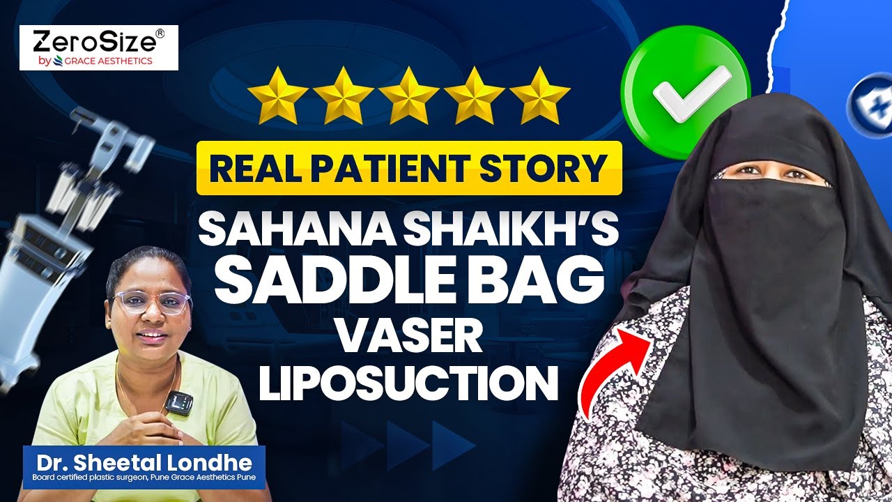 Real Patient Story: Sahana Shaikh’s Saddle Bag Vaser Liposuction