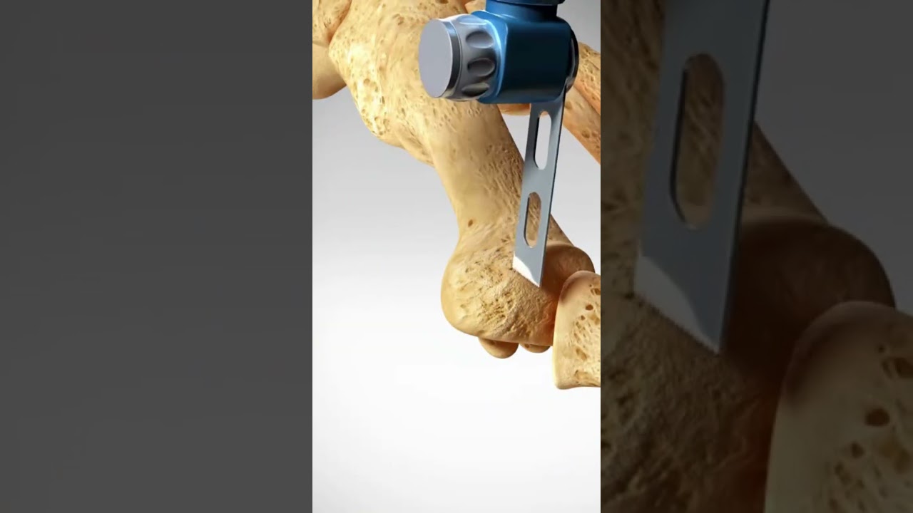 See how a Bunion is treated (Bunionectomy with Osteotomy) 