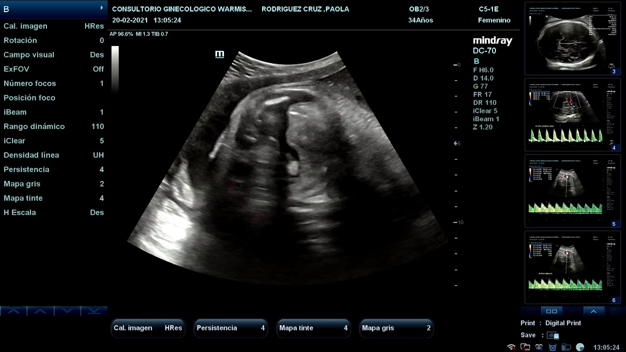 Ecografía Doppler Fetal