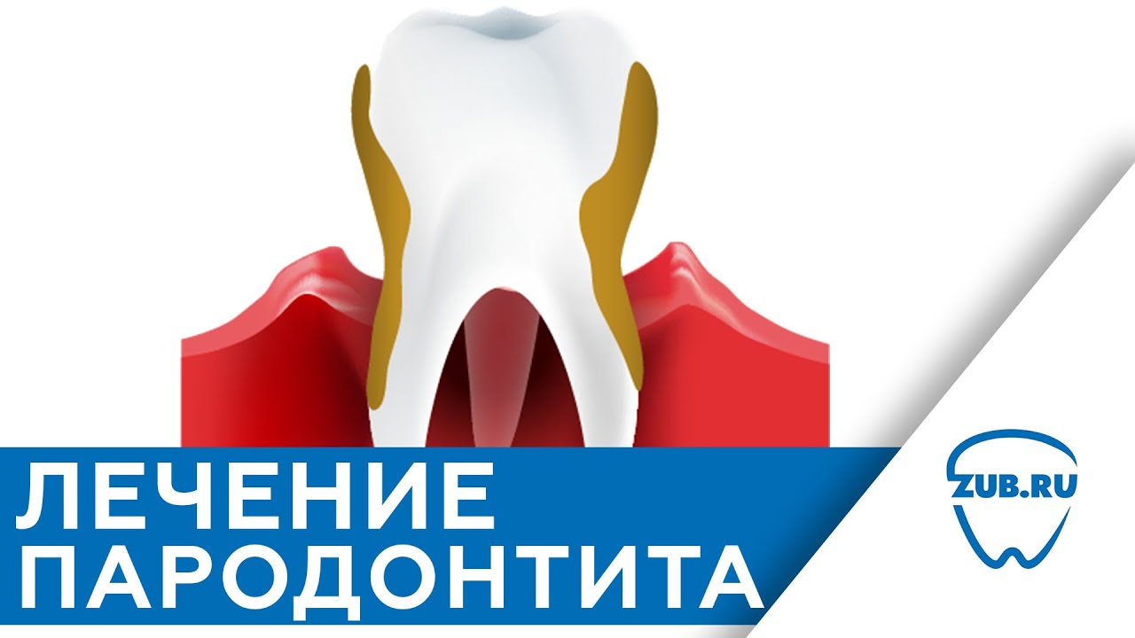 Лечение пародонтита