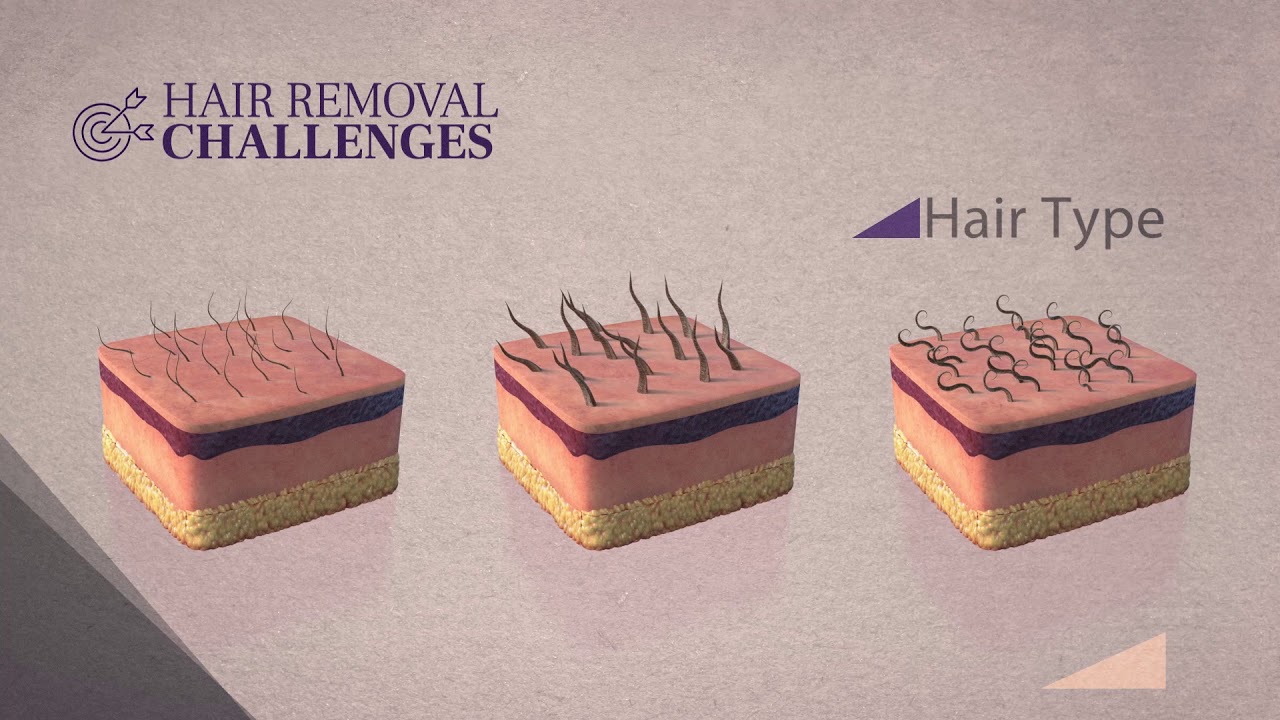 SHR 3D Technology - Soprano Titanium laser hair removal by Alma