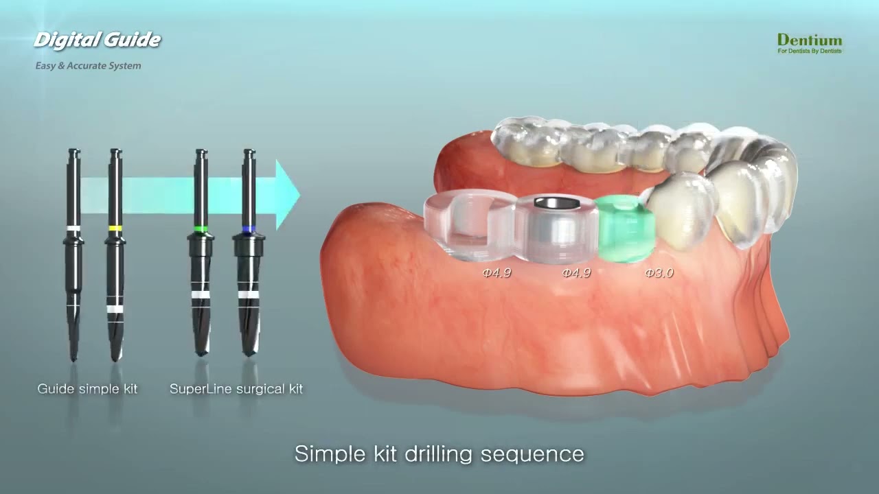 Dentium Digital Guide