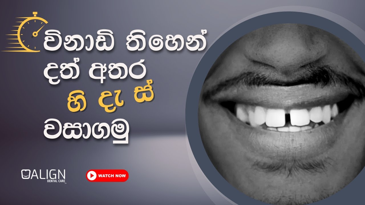 විනාඩි 30න් දත් අතර හිඩැස් වසාගත හැකිද?