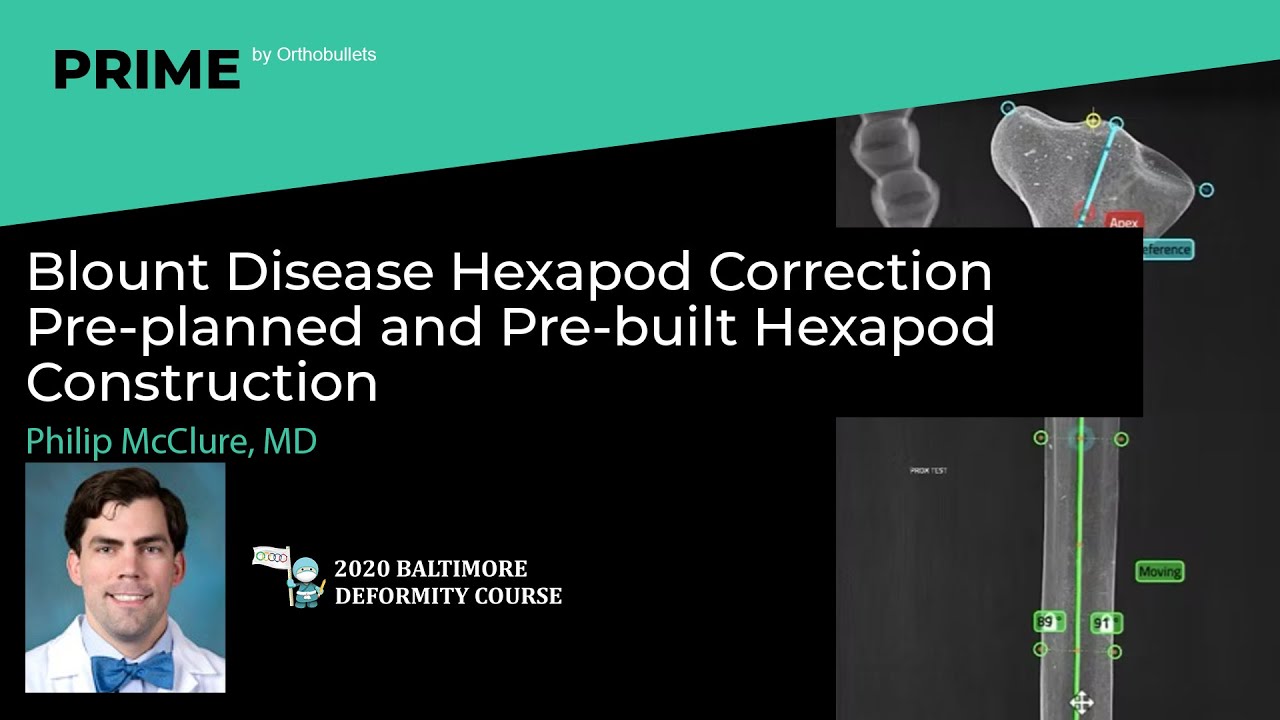 Blount Disease Hexapod Correction Pre planned and Pre built Hexapod Construction   Philip McClure, M
