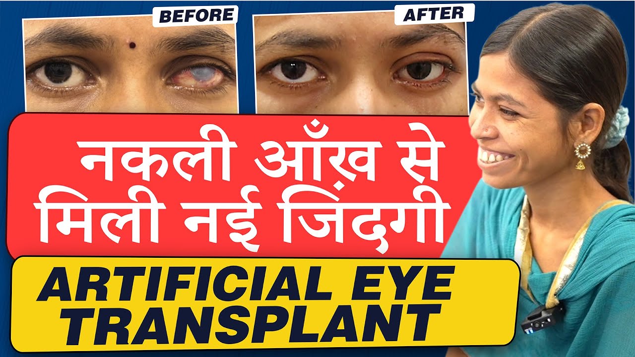 नकली आँख से मिली नयी जिंदगी  | Artificial (Prosthetic) Eye which Moves & Looks like Natural Eye