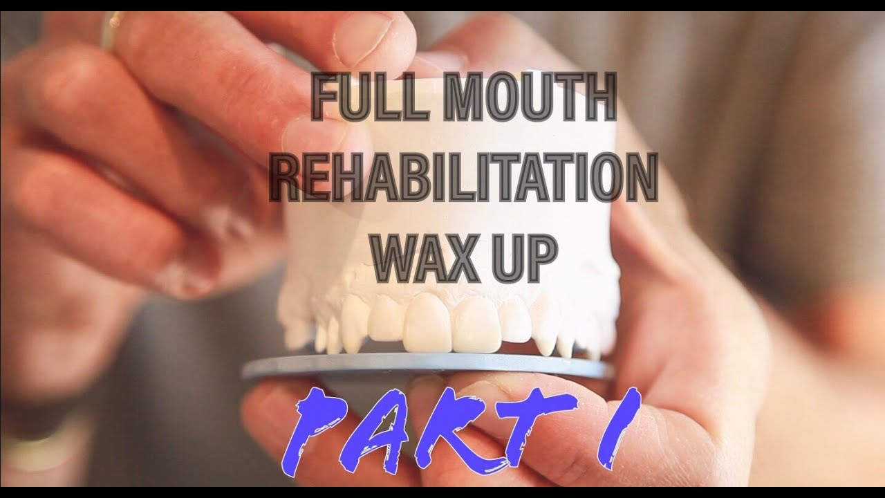 Full Mouth Dental Rehabilitation Wax Up: Part I