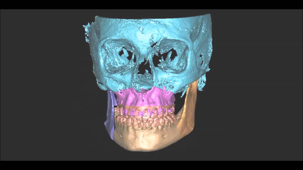 Planificación virtual 3D - Cirugía Ortognática