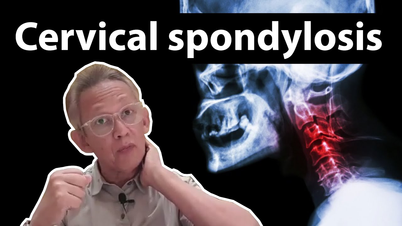 CERVICAL SPONDYLOSIS, Saraf terhimpit di Leher! | Dr. Noordin Darus
