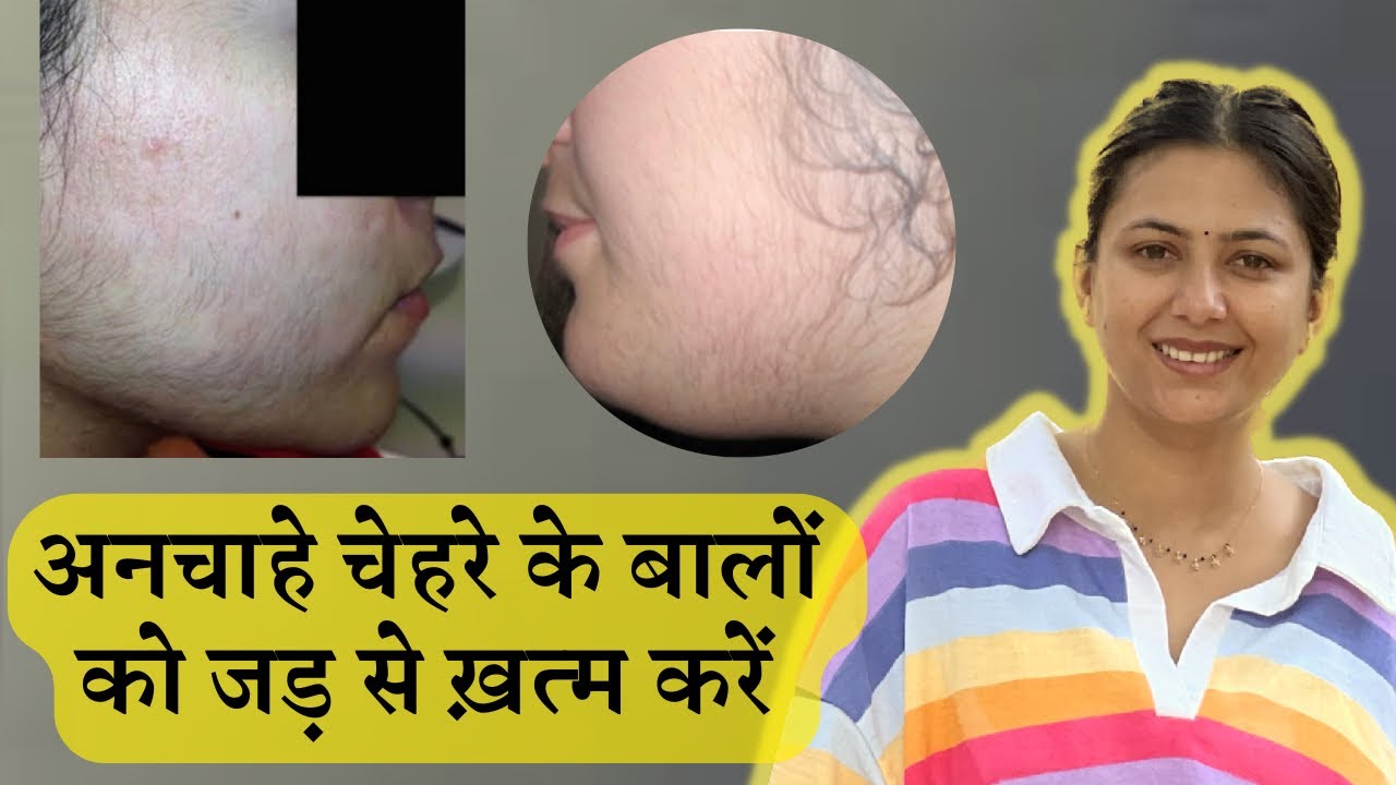 Facial Hairs ka Permanent Solution | Remove Facial Hair Hirsutism Permanently | Dr. Upasana Vohra