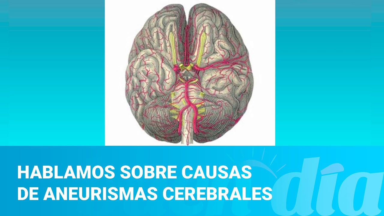 Hablamos sobre causas de aneurismas cerebrales