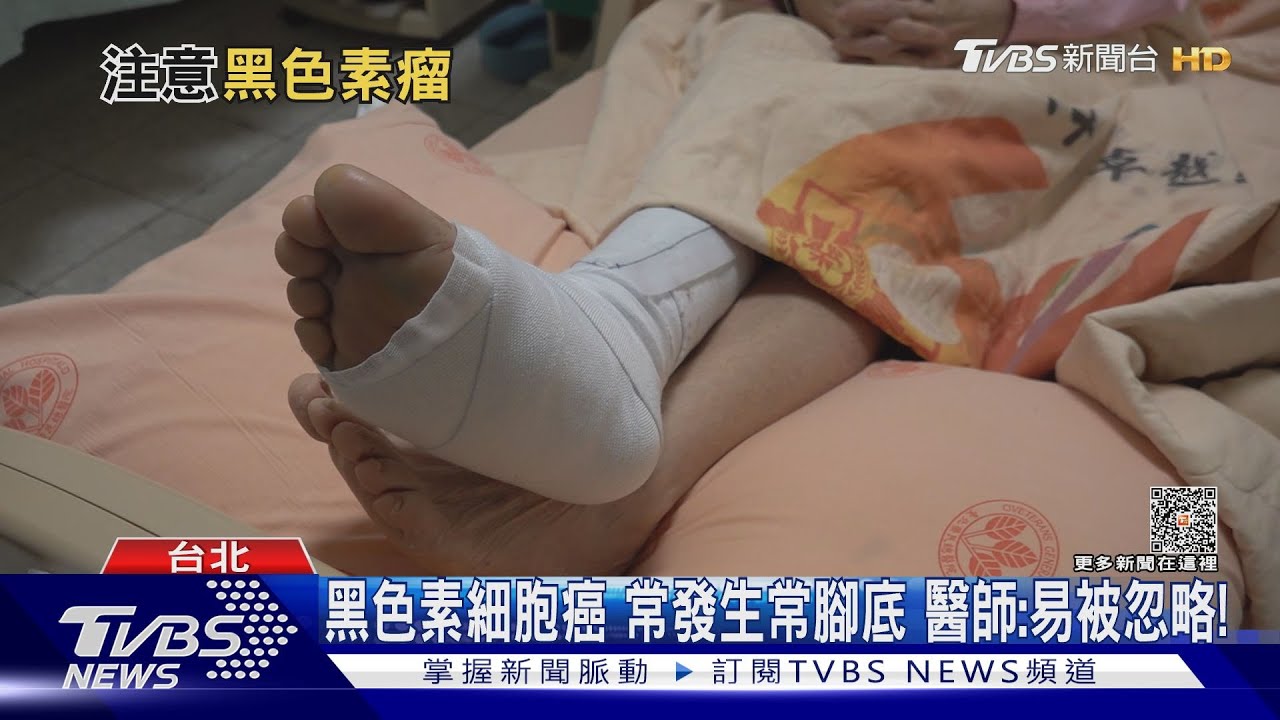 身體「這部位」...出現「黑色素沉澱」...罹「黑色素瘤機率高...盡速就醫!｜十點不一樣20230626@TVBSNEWS01
