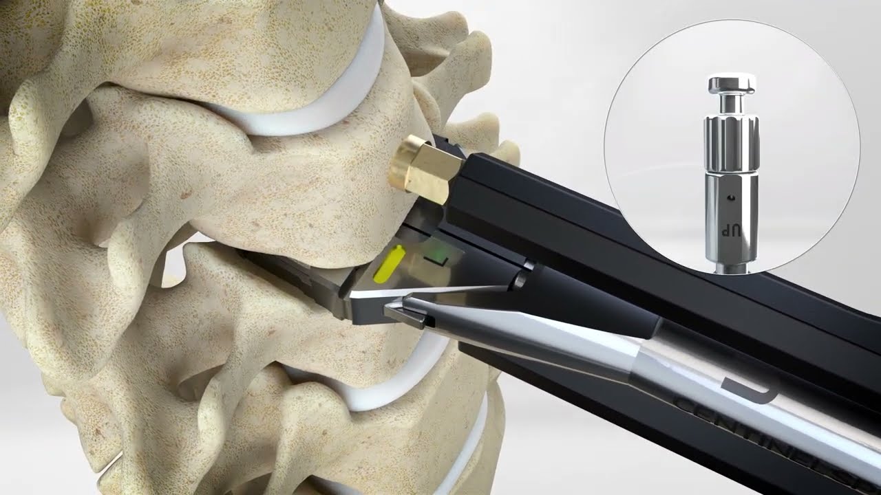 prodisc C Vivo Surgical Technique w/ prodisc Cervical V2 Instrument Set | Cervical Disc Arthroplasty