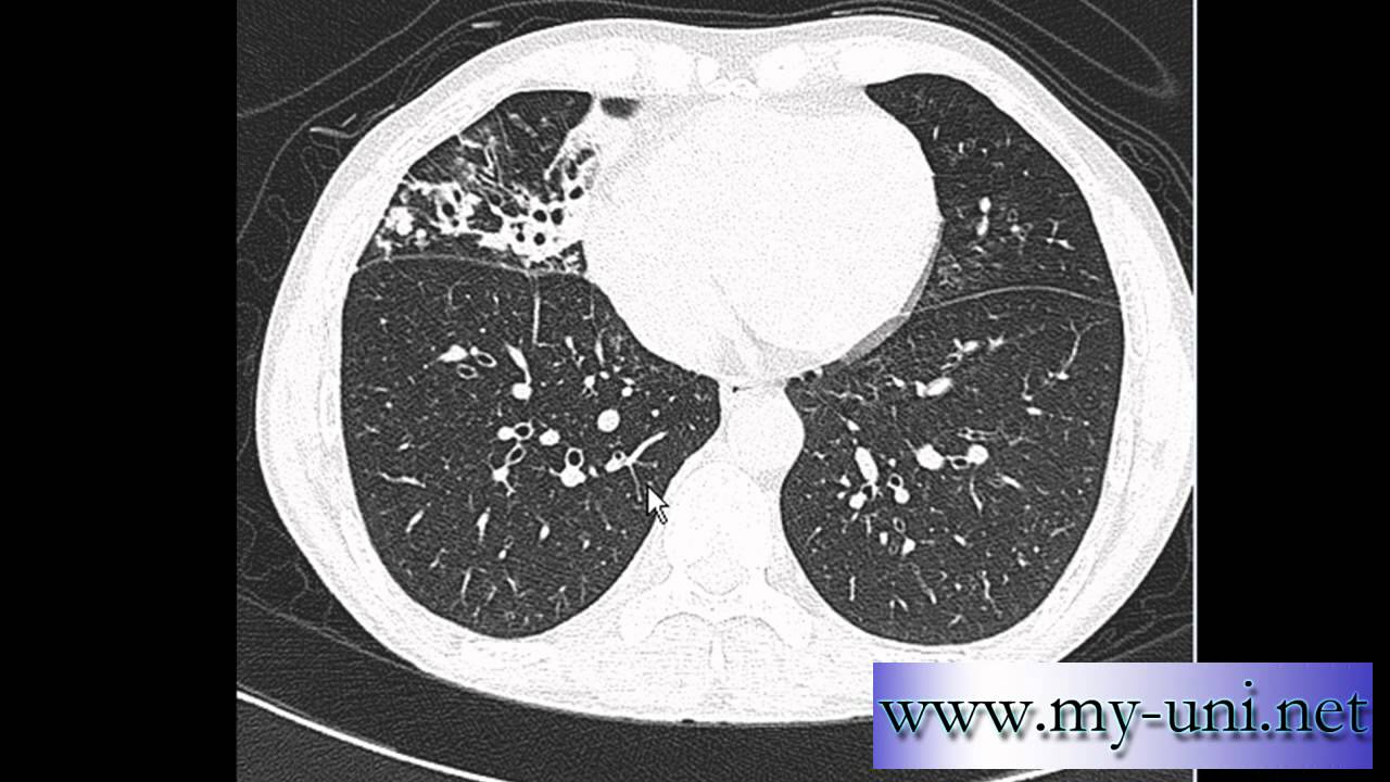 CT Chest - How to differentiate between pulmonary arteries and veins