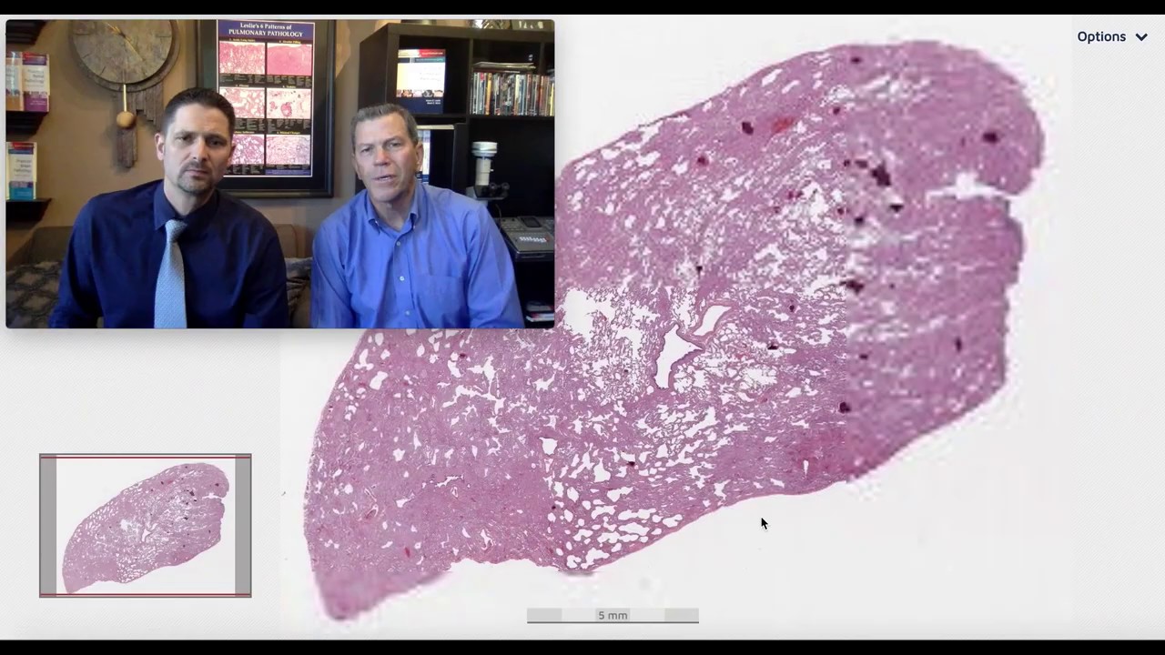 Pattern 1 - Organizing DAD mimicking NSIP with superimposed HSV infection