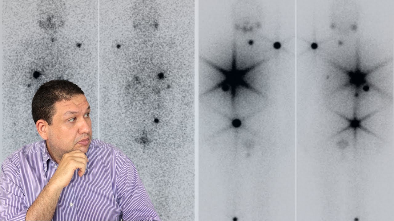 Como avaliar met&aacute;stase do c&acirc;ncer de tire&oacute;ide. PCI pesquisa de corpo inteiro no c&acirc;ncer de tire&oacute;ide.