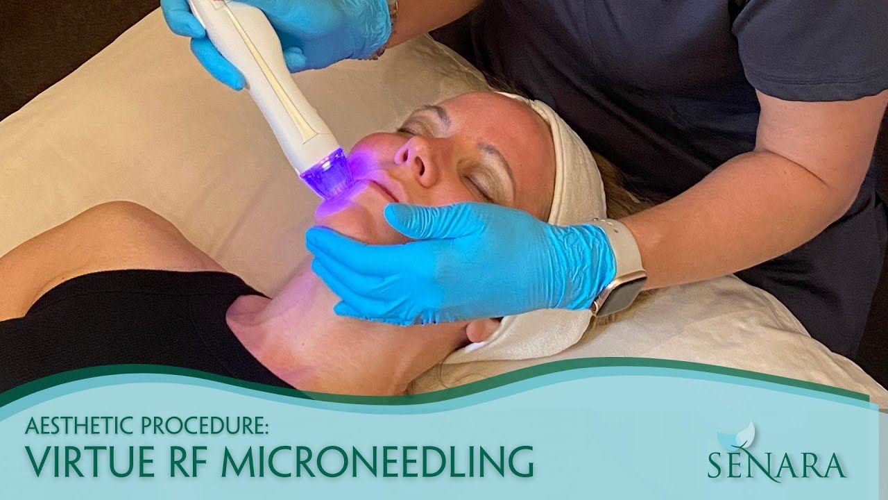 RF Microneedling Treatment Demo | Senara Health and Healing Center & Spa