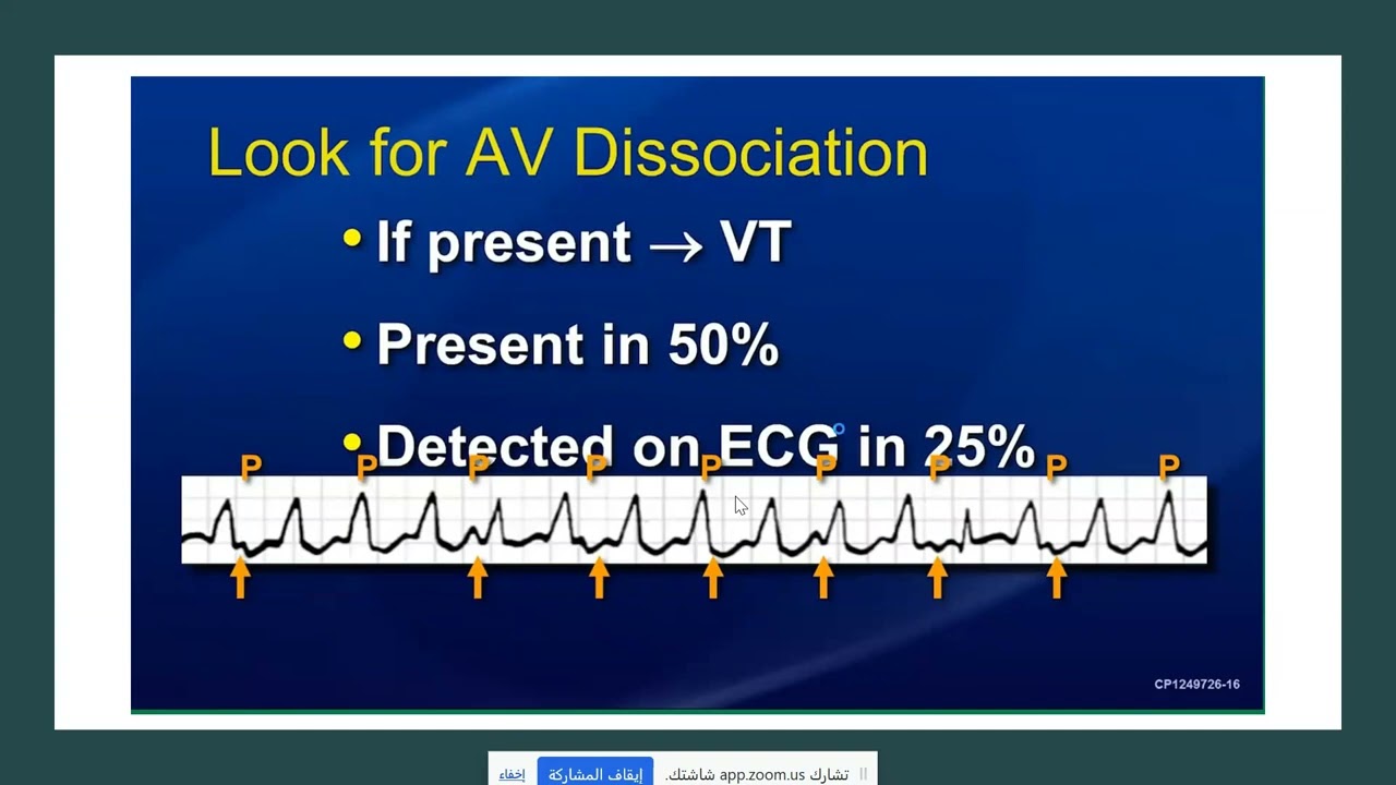 ECG in arrhythmias -Lecture 1