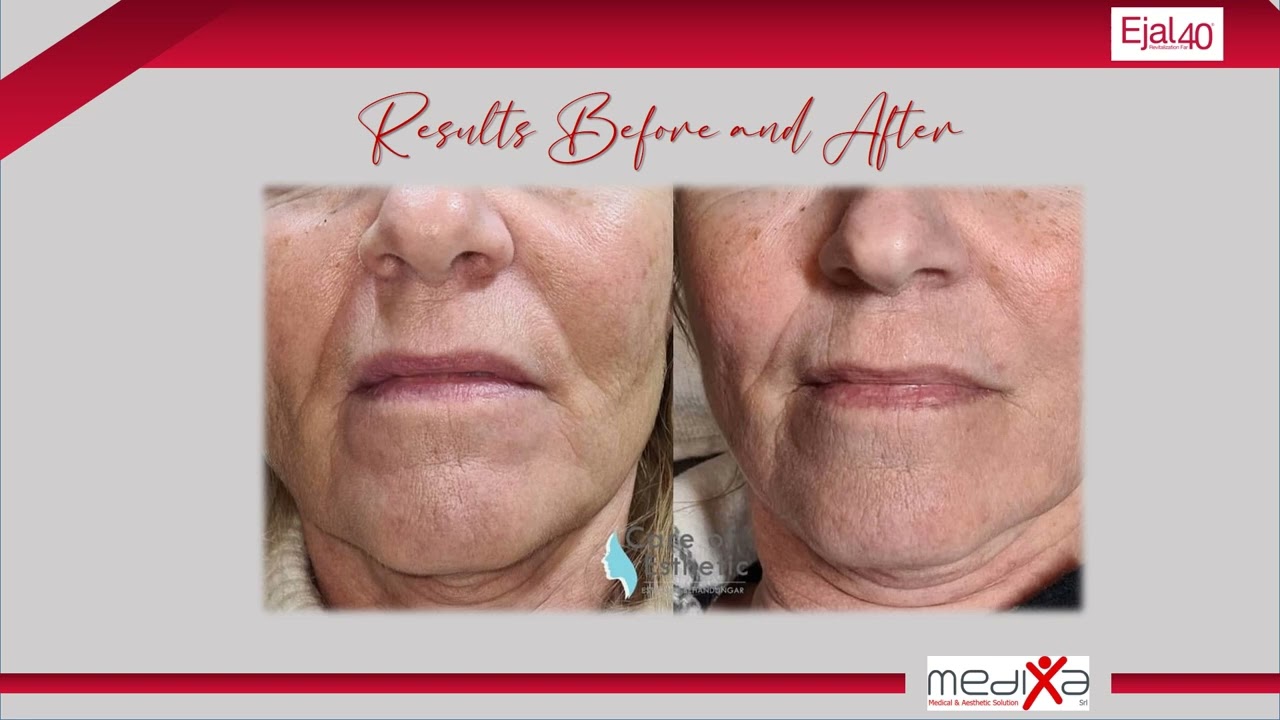 Acid hialuronic, Ejal40, Medixa, detalii produs