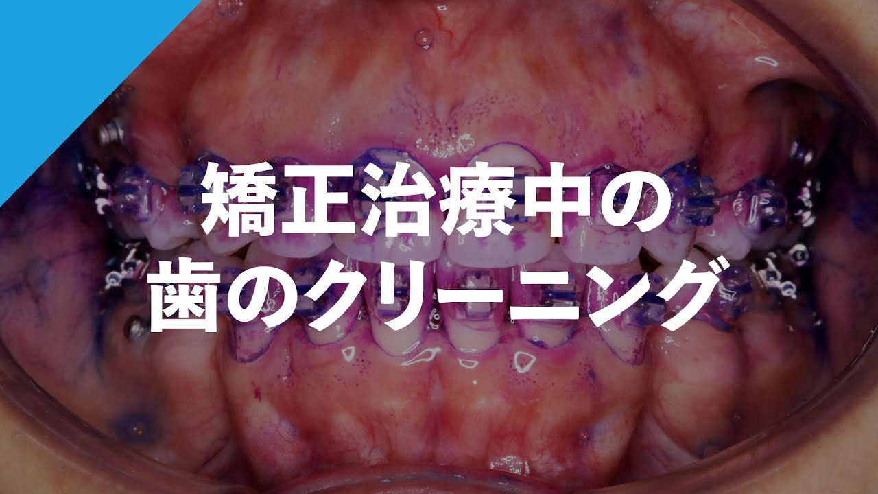歯列矯正中の歯のクリーニングは大切です【歯医者】
