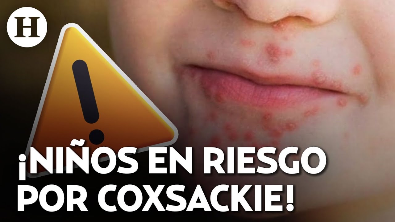 &iexcl;Alerta sanitaria por Coxsackie! Brote del virus obliga al cierre de escuelas en varios estados