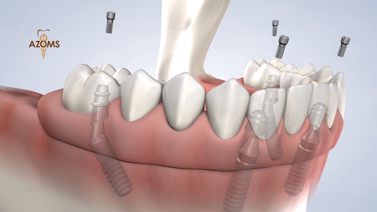 Full-Arch Replacement in Tucson AZ | Arizona Oral & Maxillofacial Surgeons