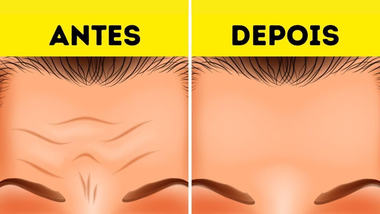 Como TIRAR as RUGAS da Testa SEM USAR BOTOX