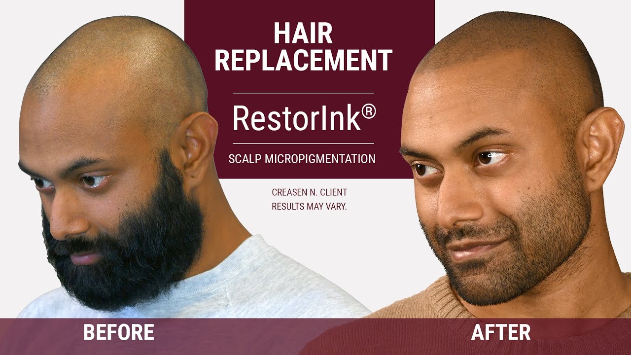 Restore your natural hairline with scalp micropigmentation | RestorInk&reg;