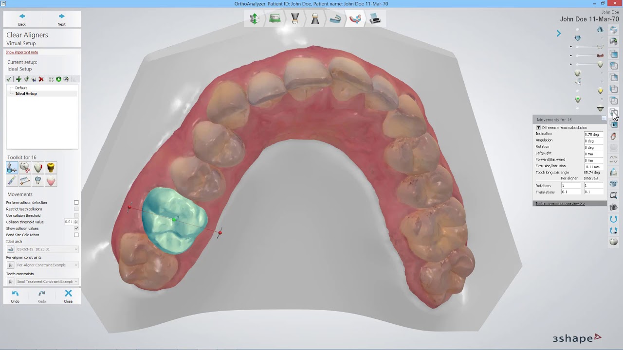 3Shape Clear Aligner Studio - Teeth movement in Virtual Setup BR-PT