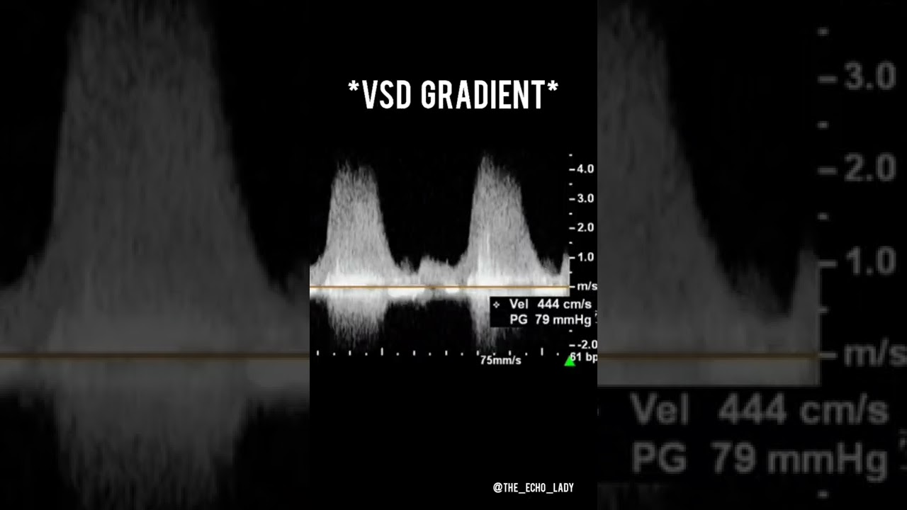Case of the day: VSD!
