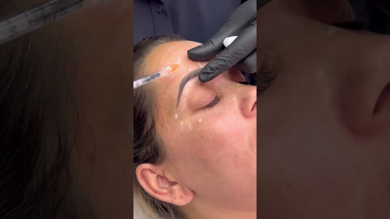 Botox - aplica&ccedil;&atilde;o r&aacute;pida e tranquila