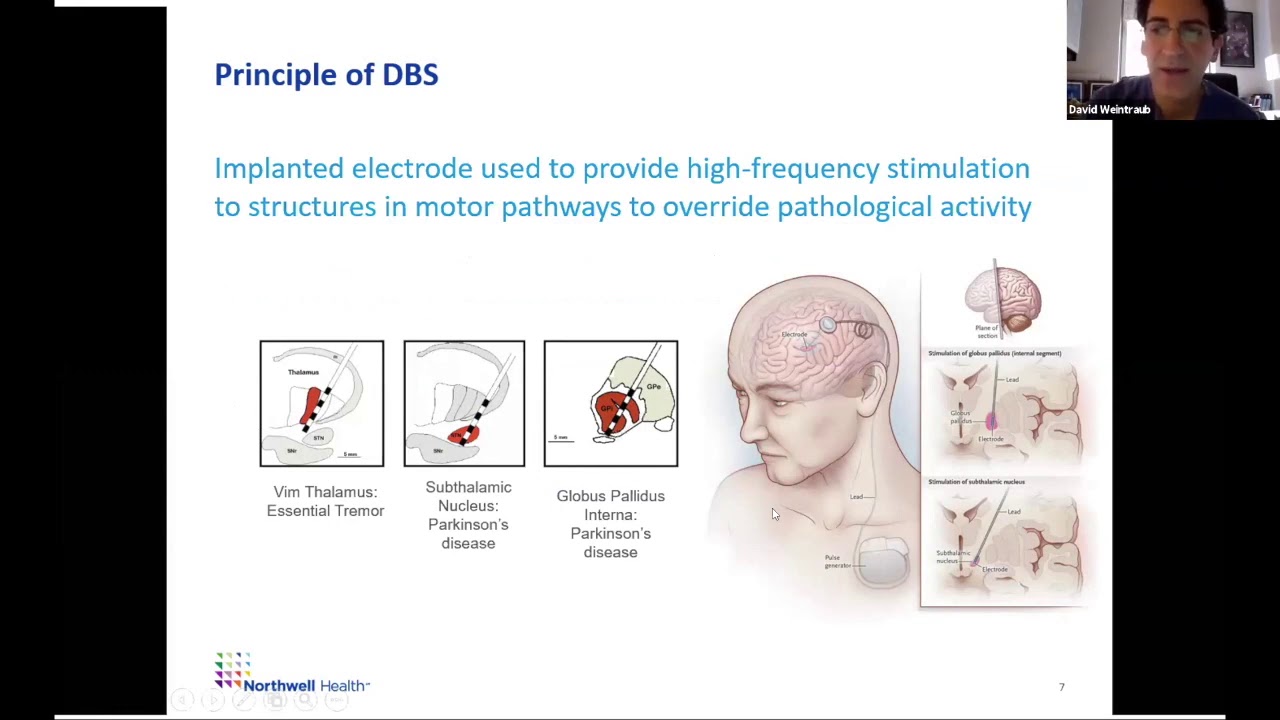 Neurosurgery Subspecialty: Deep Brain Stimulation Surgery with Dr. David Weintraub