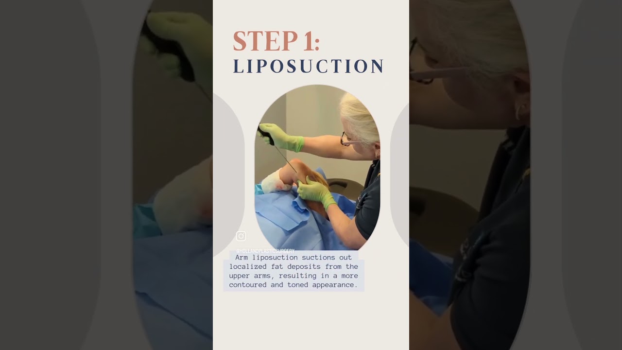 Renuvion Skin Tightening with Liposuctions - Arms
